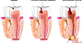 Как лечить кариес в домашних условиях?