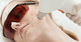 Эффективные процедуры от постакне