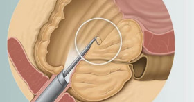 Восстановление мочеиспускания после резекции или удаления предстательной железы