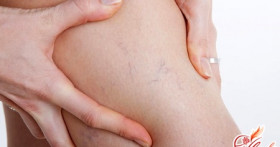 Специфика лечения варикоза