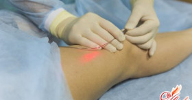 Как происходит лечение варикоза лазером?