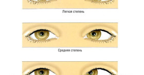 Амблиопия и армия