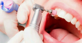 Особенности профессиональной чистки зубов