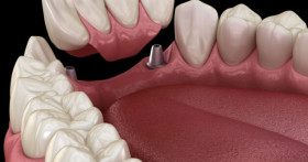 Имплантация на четырех имплантах в Минске