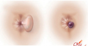 Лечение тромбоза геморроидального узла при беременности и после родов