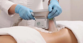 Что лучше криолиполиз или липосакция?