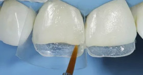 Современные методы реставрации зубов