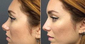 Ринопластика: стоит ли делать?