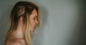 Трихотилломания: разгадка скрытой борьбы с собой