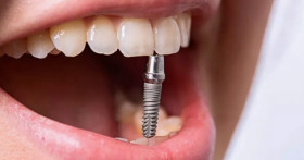 Ставим зубные импланты