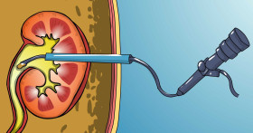 Кому и когда нужна или противопоказана резекция почки?