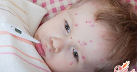 Высыпания на коже ребенка после температуры