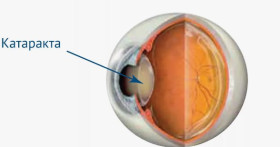 Как определить, когда нужно удалять катаракту
