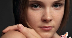 Пигментные пятна и способы борьбы с ними