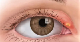 Что способствует частому образованию ячменя и как это предотвратить