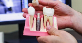 Стоит ли делать имплантацию?