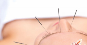 Иглоукалывание для похудения