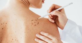 Как распознать рак кожи на ранней стадии?