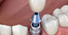 Всё, что нужно знать об установке зубных коронок: выбор и этапы процедуры