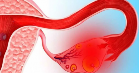 Апоплексия яичника: причины, симптомы, лечение