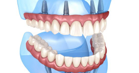 Долгосрочная надежность и эффективность All-on-4 имплантации