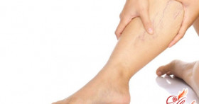 Развитие варикоза – лечение сеточек на ногах