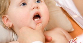 Молочница у малыша: профилактика и лечение