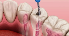 Удаление нерва зуба