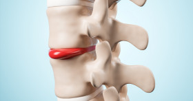 Симптомы и лечение межпозвоночной грыжи