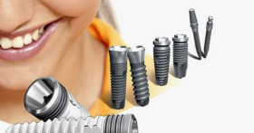 Премиальные или бюджетные импланты: что лучше выбрать?