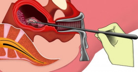 Выскабливание эндометрия современными методами