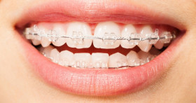 Виды брекет-систем, какие лучше?