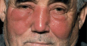 Что такое рожа на лице и как ее лечить?