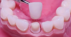 Как установить коронки на зубы