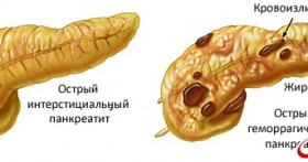 Какие симптомы сигнализируют о болезнях в поджелудочной железе?
