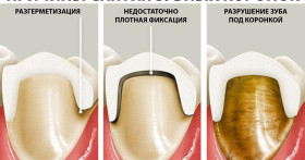 Как часто нужно менять зубные коронки