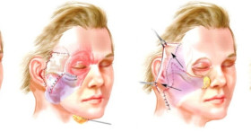 Пластическая подтяжка нижней трети лица