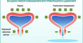 Стрессовое недержание мочи: причины и лечение
