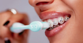 Правила ухода за зубами во во время ношения брекетов