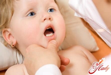 Молочница у малыша: профилактика и лечение