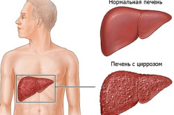 Цирроз печени - одна из причин запора и вздутия живота
