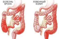Болезнь Крона и язвенный колит - причины возникновения поноса