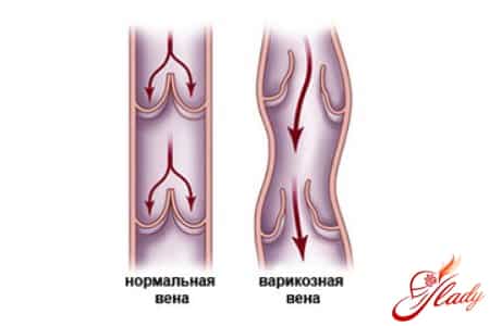 Состояние вен при варикозе