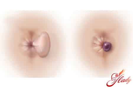 Тромбоз геморроидального узла при беременности