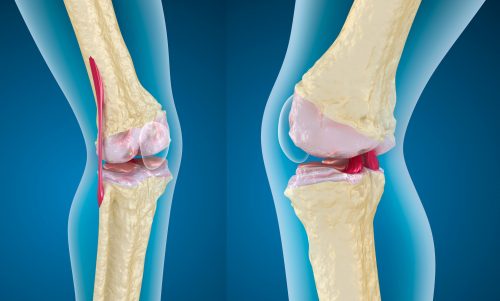 Симптомы и лечение артроза коленного сустава
