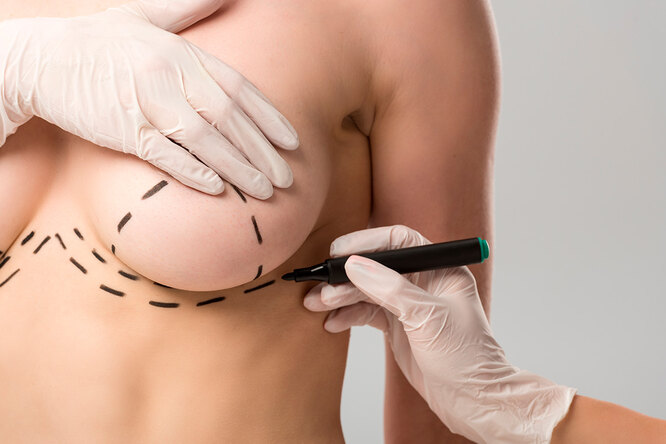 Что такое мастопексия и для чего она проводится