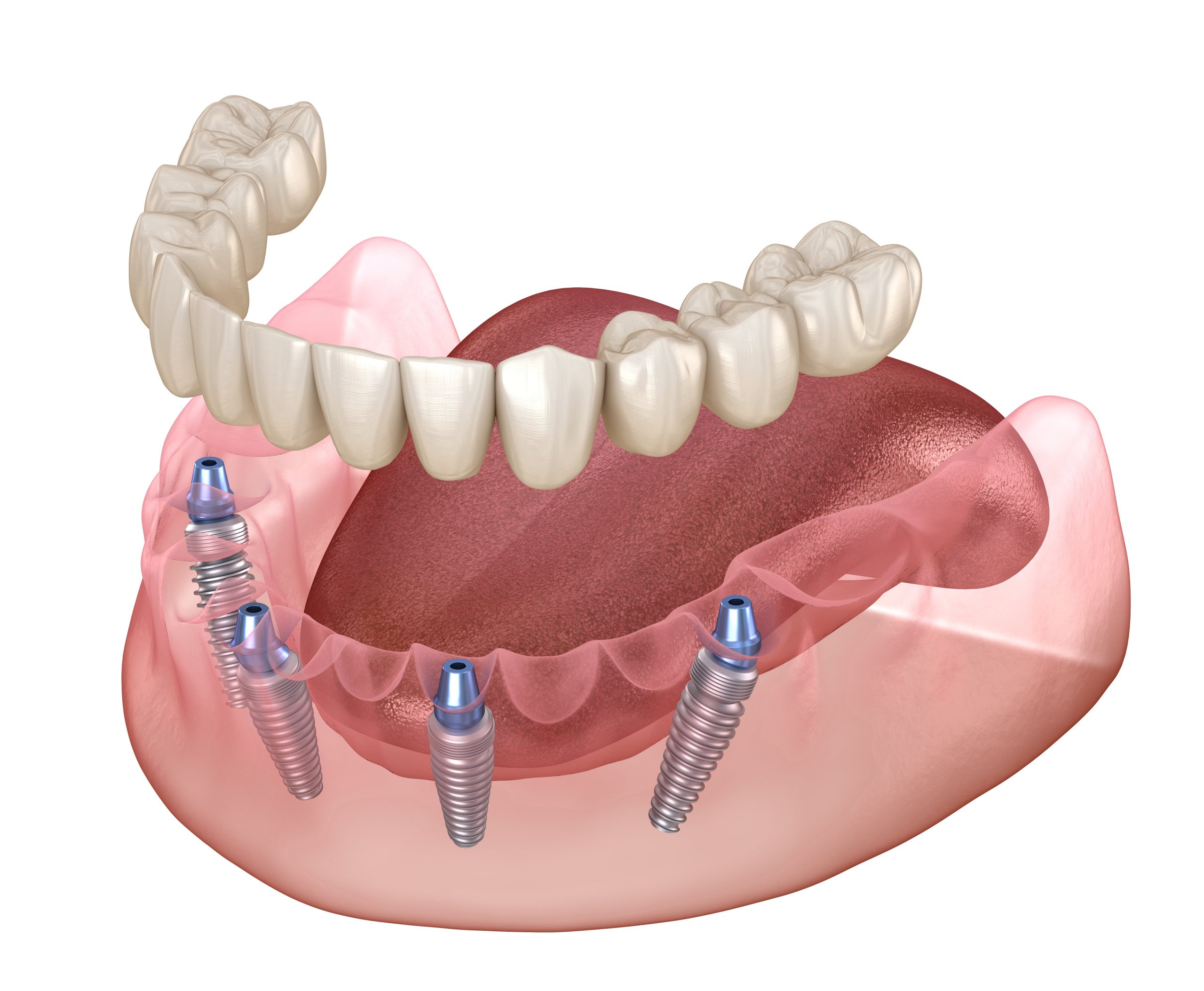 Имплантация зубов all on 4: показания, особенности и преимущества