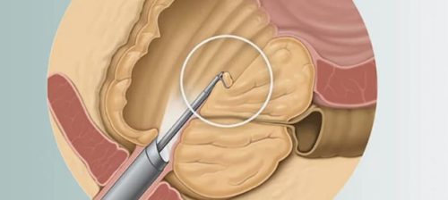 Удаления полипа мочевого пузыря