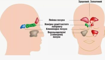 Клинические рекомендации при остром синусите