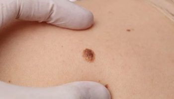 Меланома: факторы риска и профилактика